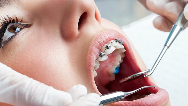 Orthodontics Treatments in Chandigarh