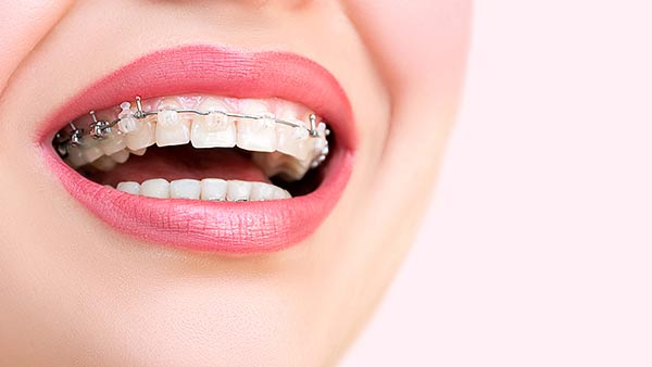Adult Orthodontics - Dentists Panchkula