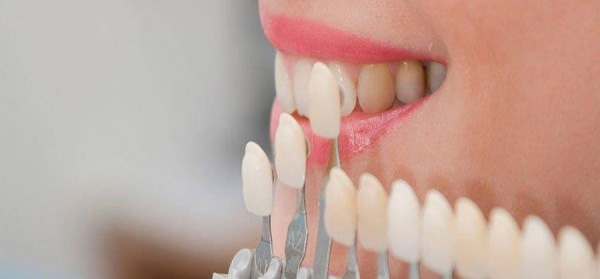 Dental Veneers - Chandigarh