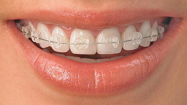 Orthodontics Treatments in Chandigarh