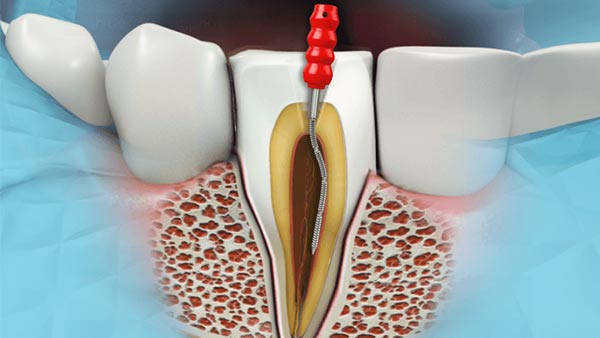 Endodontic Surgery