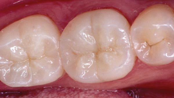 White Fillings Treatment - Chandigarh